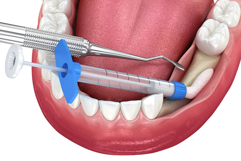 Bone Grafting in Chicago